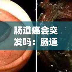 腸道癌會突發嗎：腸道癌會怎么樣 