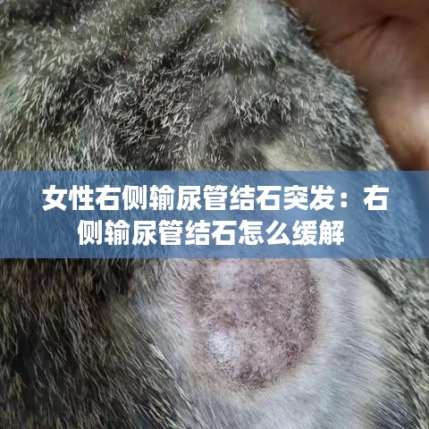 女性右側輸尿管結石突發(fā)：右側輸尿管結石怎么緩解 