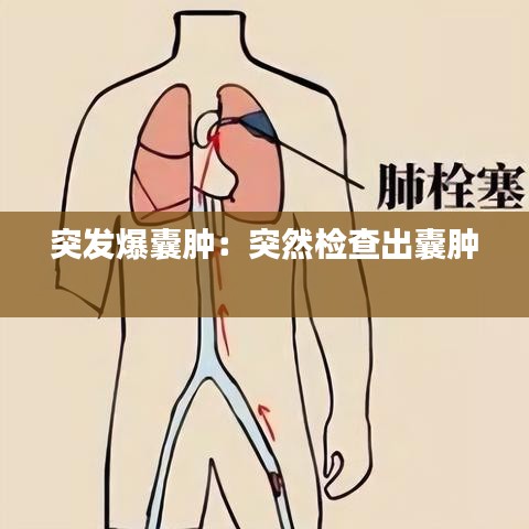 突發爆囊腫：突然檢查出囊腫 