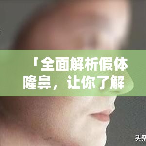 「全面解析假體隆鼻,讓你了解所有細節!」