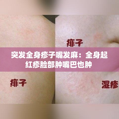 突發全身疹子嘴發麻:全身起紅疹臉部腫嘴巴也腫
