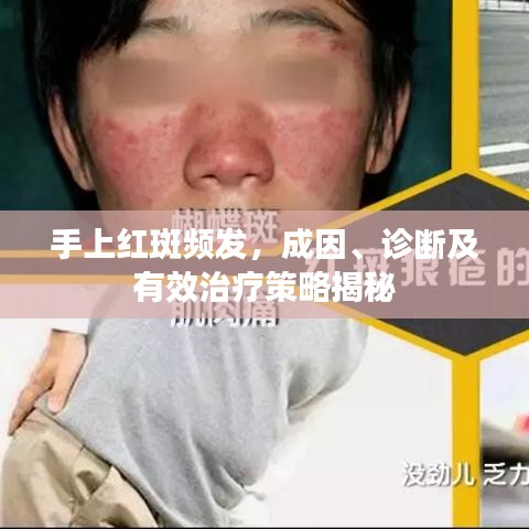 手上紅斑頻發(fā),成因、診斷及有效治療策略揭秘