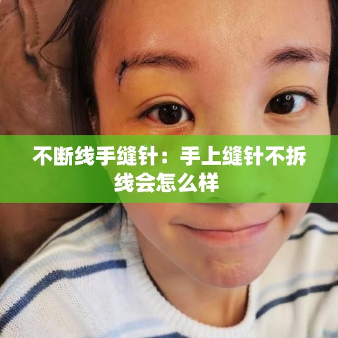不斷線手縫針:手上縫針不拆線會怎么樣