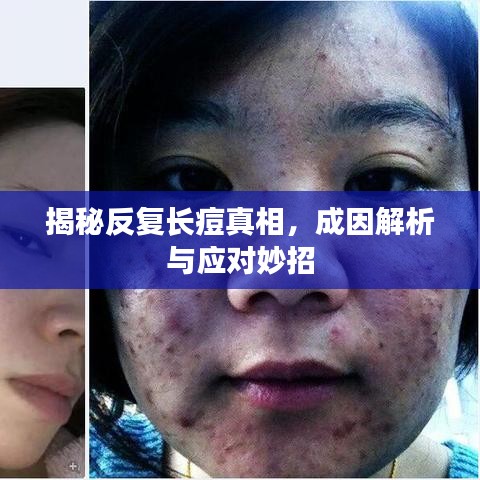 揭秘反復(fù)長(zhǎng)痘真相，成因解析與應(yīng)對(duì)妙招
