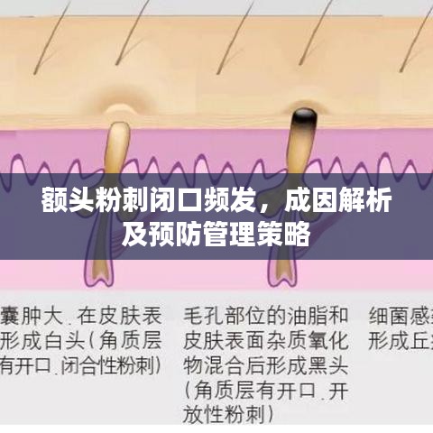 額頭粉刺閉口頻發(fā)，成因解析及預(yù)防管理策略