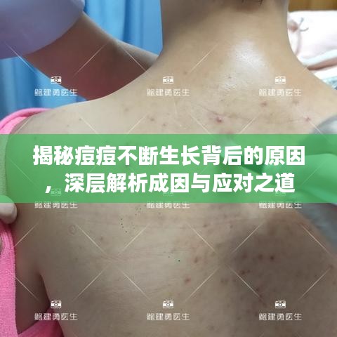 揭秘痘痘不斷生長(zhǎng)背后的原因，深層解析成因與應(yīng)對(duì)之道