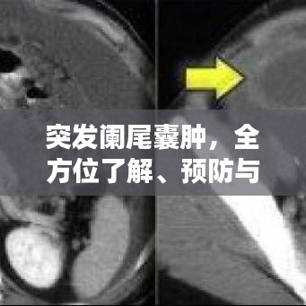 突發(fā)闌尾囊腫,全方位了解、預(yù)防與治療策略