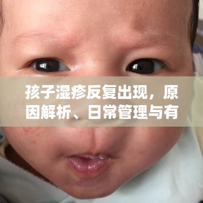 孩子濕疹反復出現(xiàn),原因解析、日常管理與有效治療策略